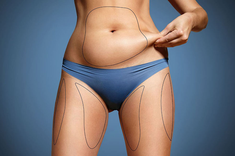 Body Sculpting vs. Liposuction